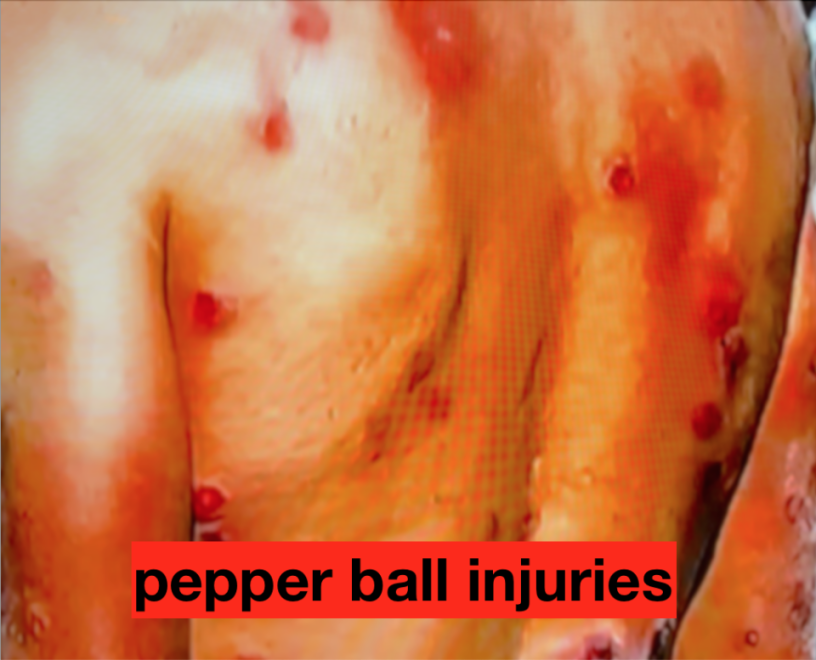 injuries_from_pepper_balls.png injuries_from_pepper_balls.png
